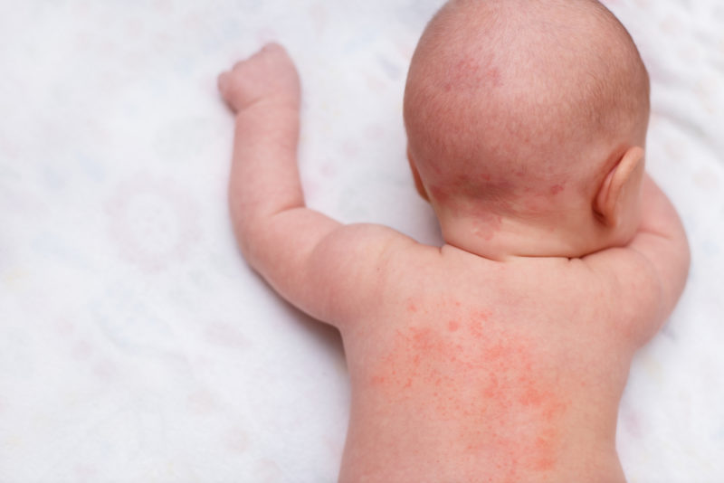 赤ちゃんの乳児湿疹 からの アトピー Tueetエネルギー量子医学会メタトロン